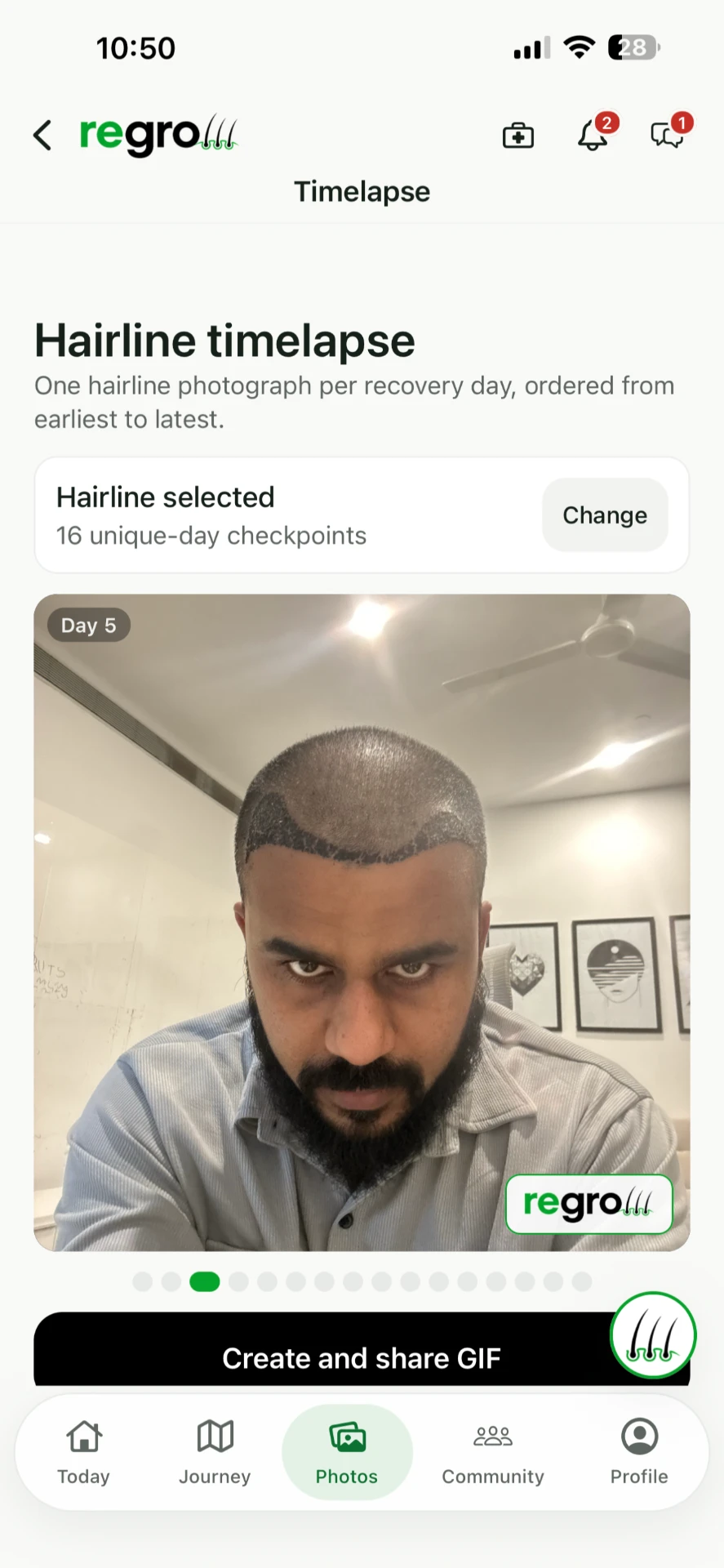 Regrow hairline time-lapse screen with day checkpoints