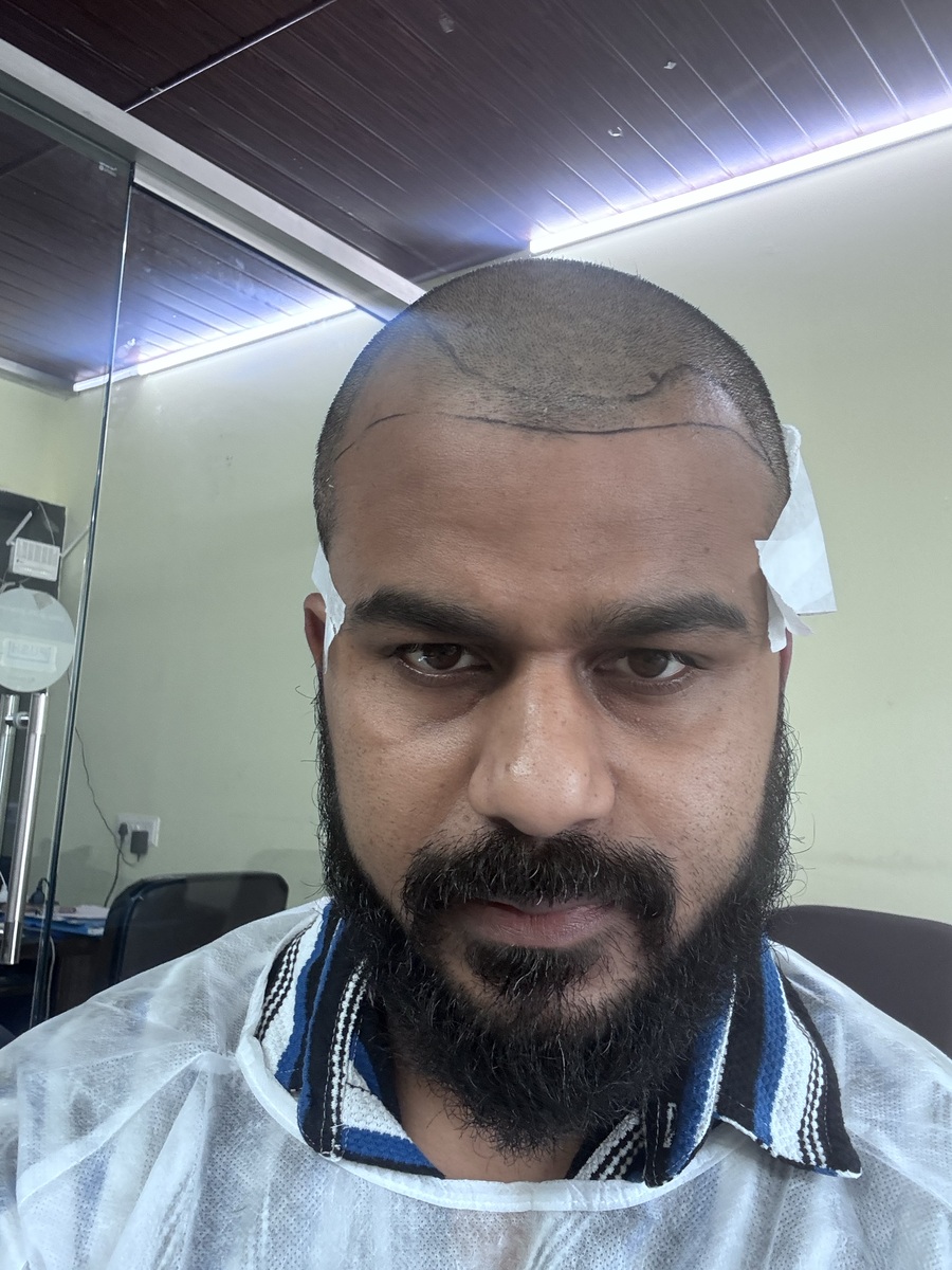 Vikrant's pre-surgery hairline photograph, 18 Jul 2026.